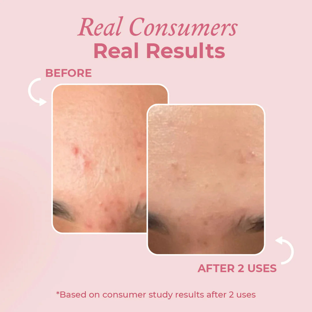 Smarter, Stronger & More Affordable Than Acne Dots 💎